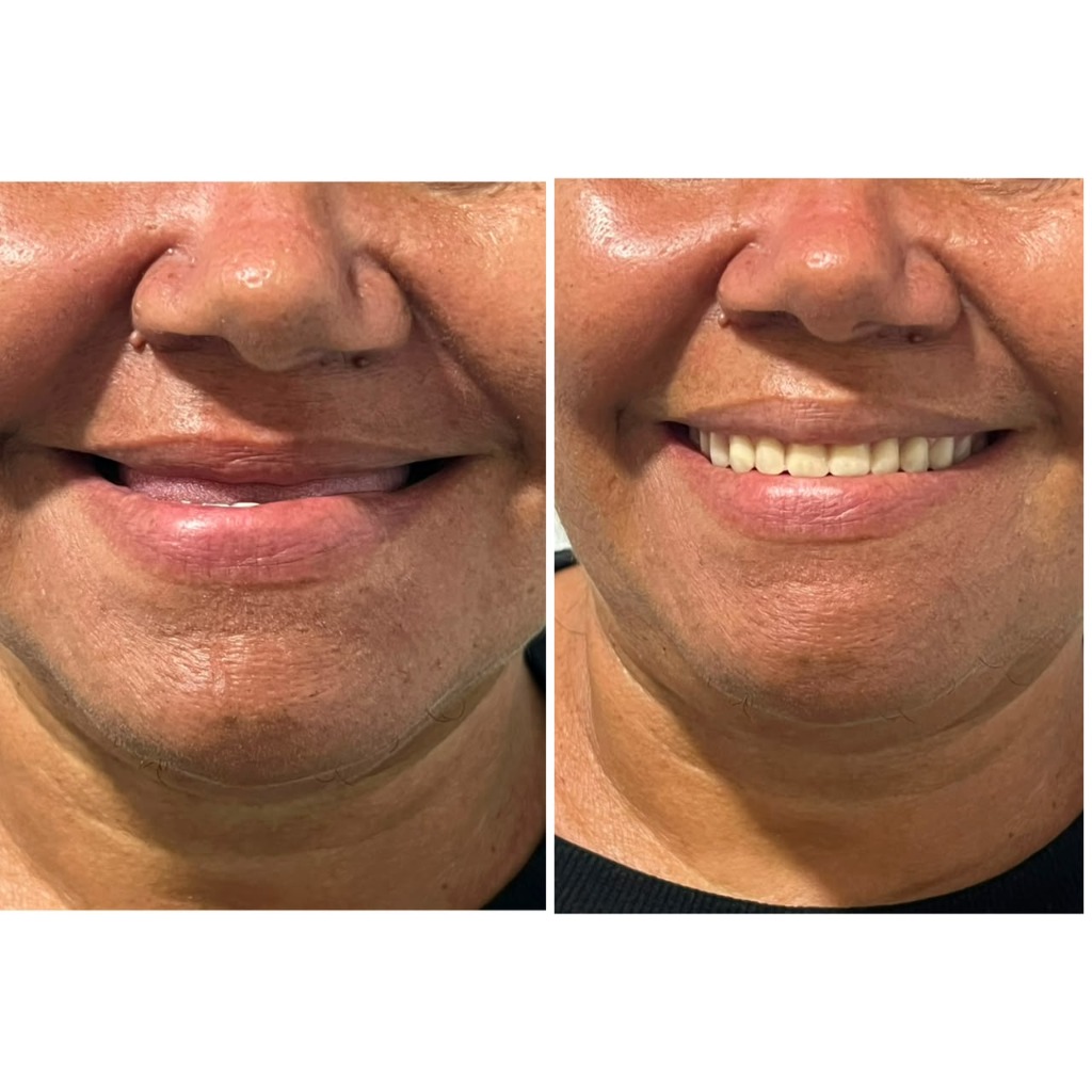 Antes e depois de reabilitação com prótese dentária